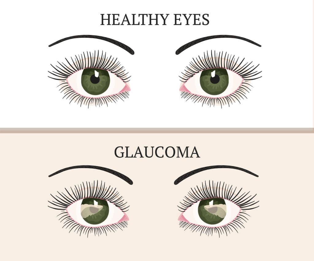 Senior Care in Pleasant Hill CA: Glaucoma Tips