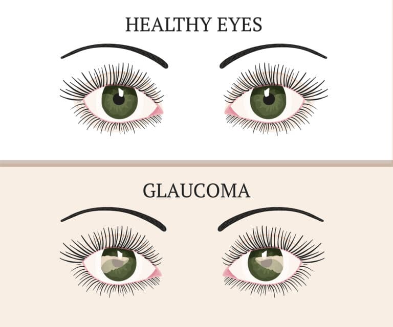 Senior Care in Pleasant Hill CA: Glaucoma Tips