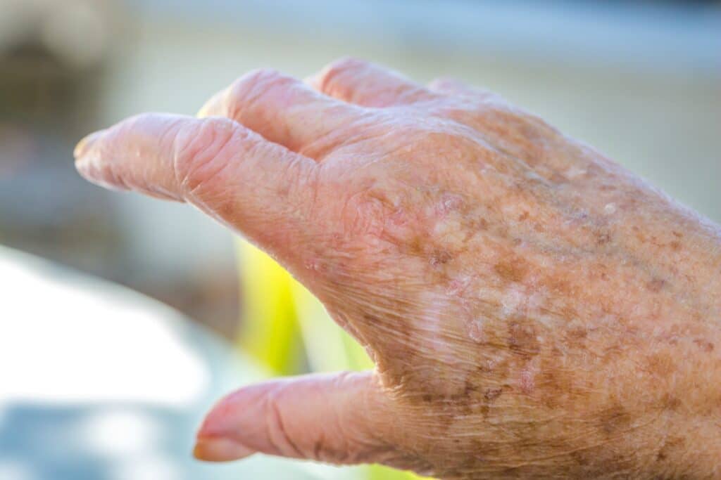 Homecare in Oakland CA: Senior Skin Tears