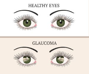 Senior Care in San Mateo CA: Helping With Glaucoma