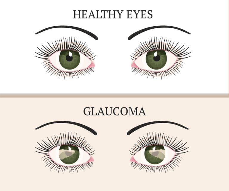 Senior Care in San Mateo CA: Helping With Glaucoma